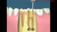 /album/fotogaleria-endodoncia/a2-png6/