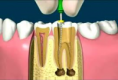 /album/fotogaleria-endodoncia/a3-png4/